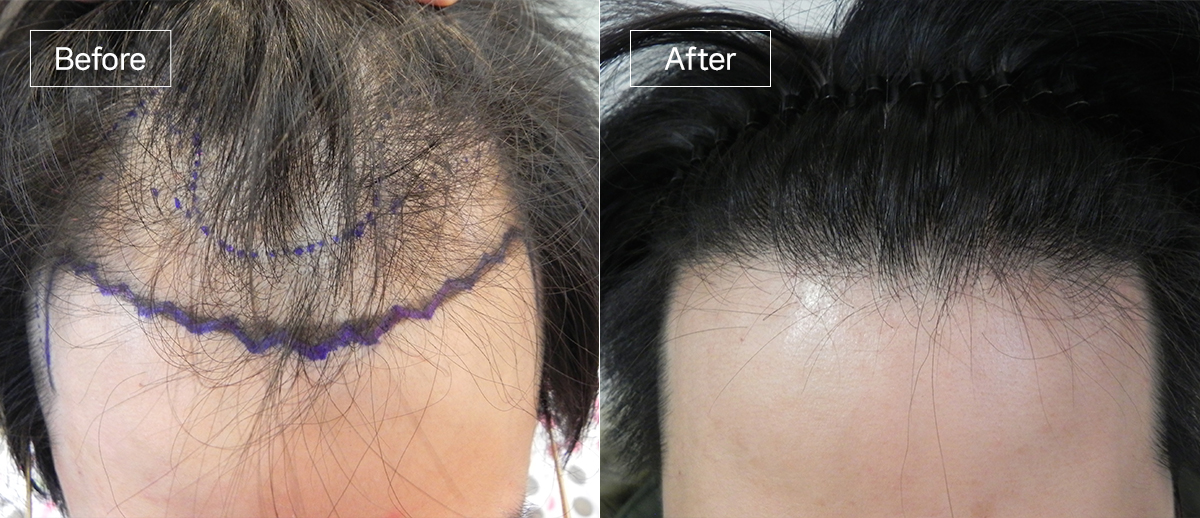 /filedata/md_board/20251229125808_T7Ms0U82_sub1_slide1.jpg 전후사진