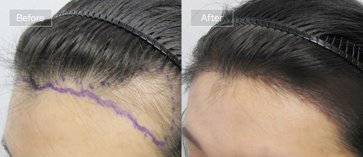 /filedata/md_board/20260102171831_PRfEQNeb_sub3_slide4.jpg 전후사진