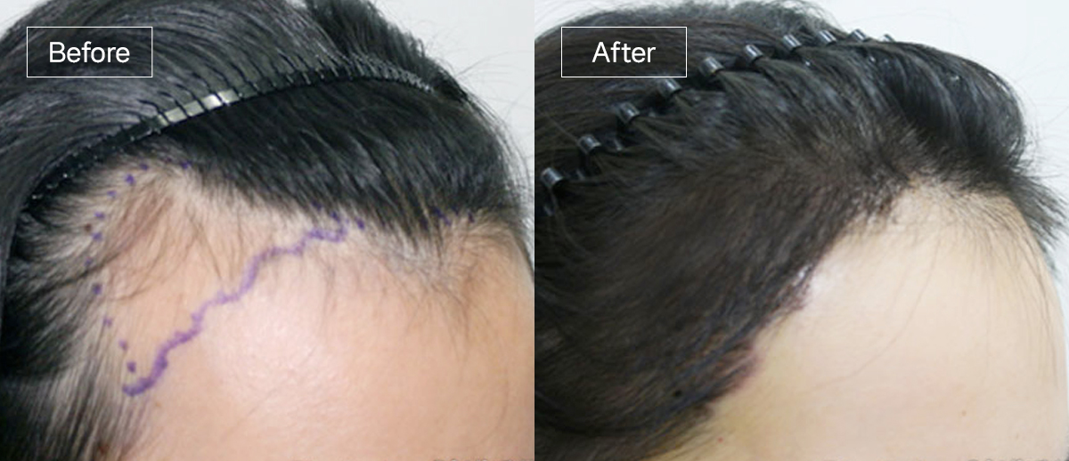 /filedata/md_board/20260102171840_wyld0NOu_sub3_slide3.jpg 전후사진