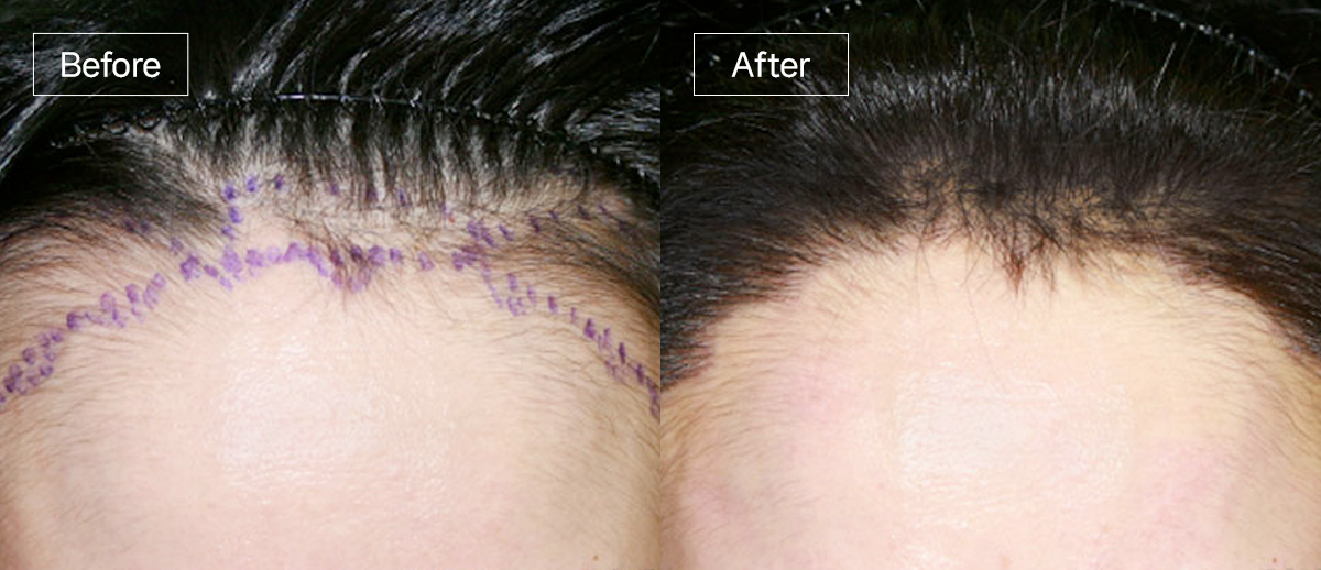 /filedata/md_board/20260102171854_uFkxKw6U_sub3_slide2.jpg 전후사진