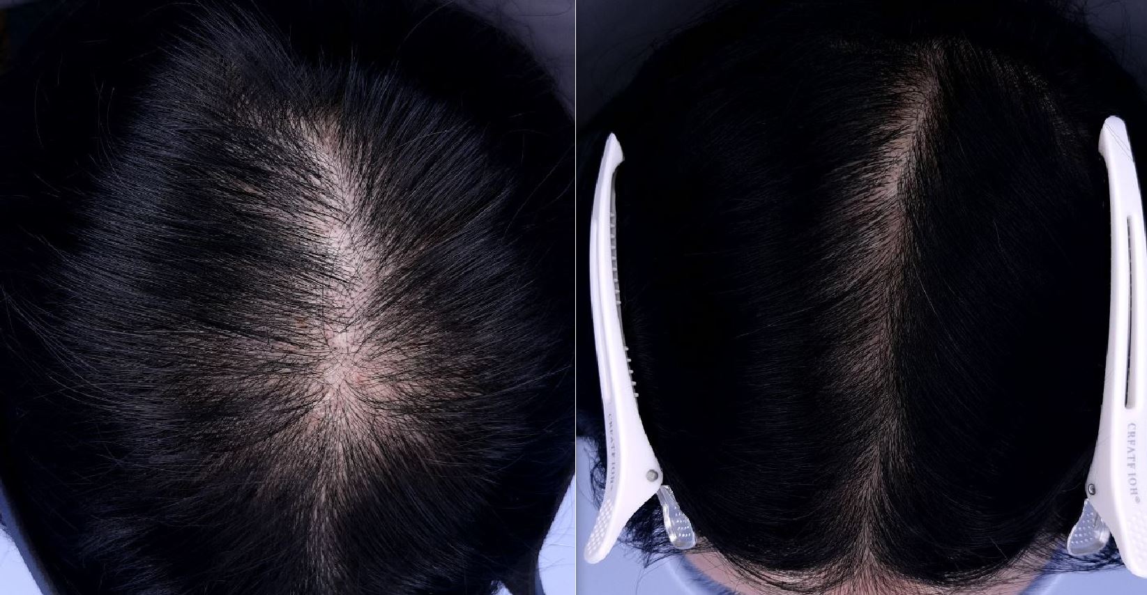 /filedata/md_board/20260212141041_IhBkwjfx_KakaoTalk_20260212_125710719_01.jpg 전후사진