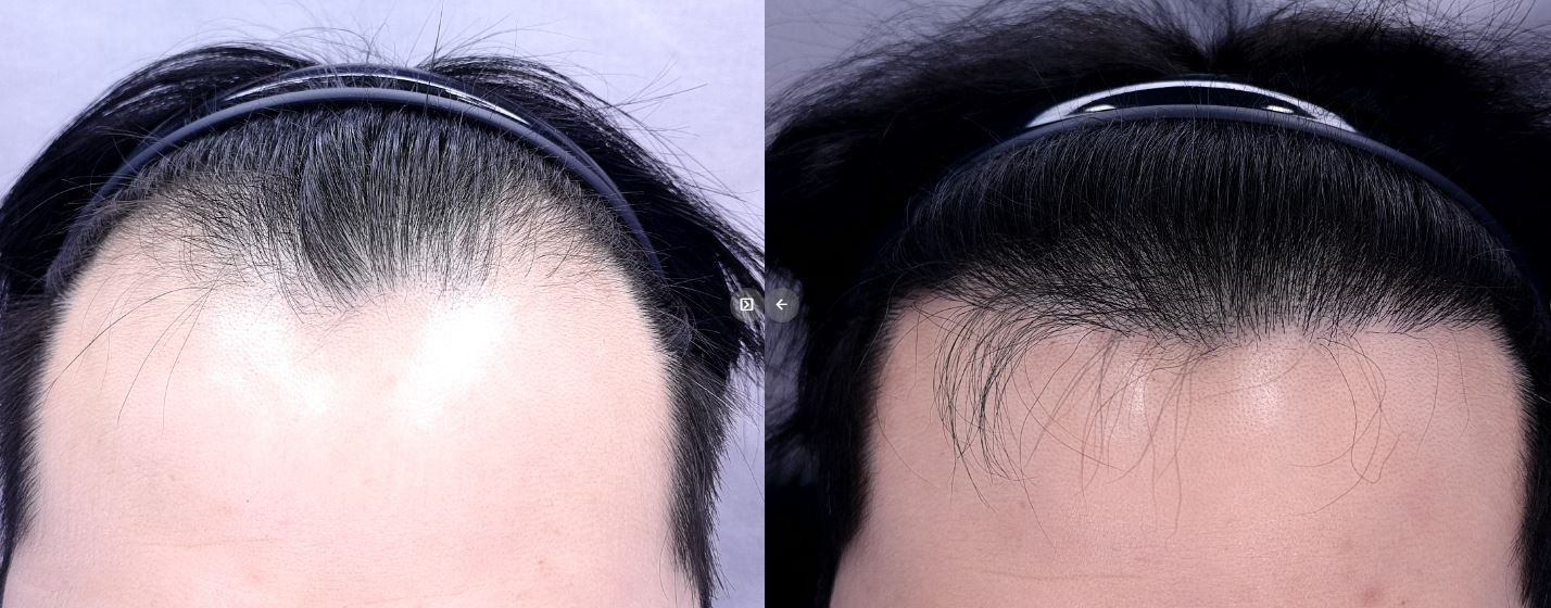 /filedata/md_board/20260212141610_kH8y04rc_2.jpg 전후사진