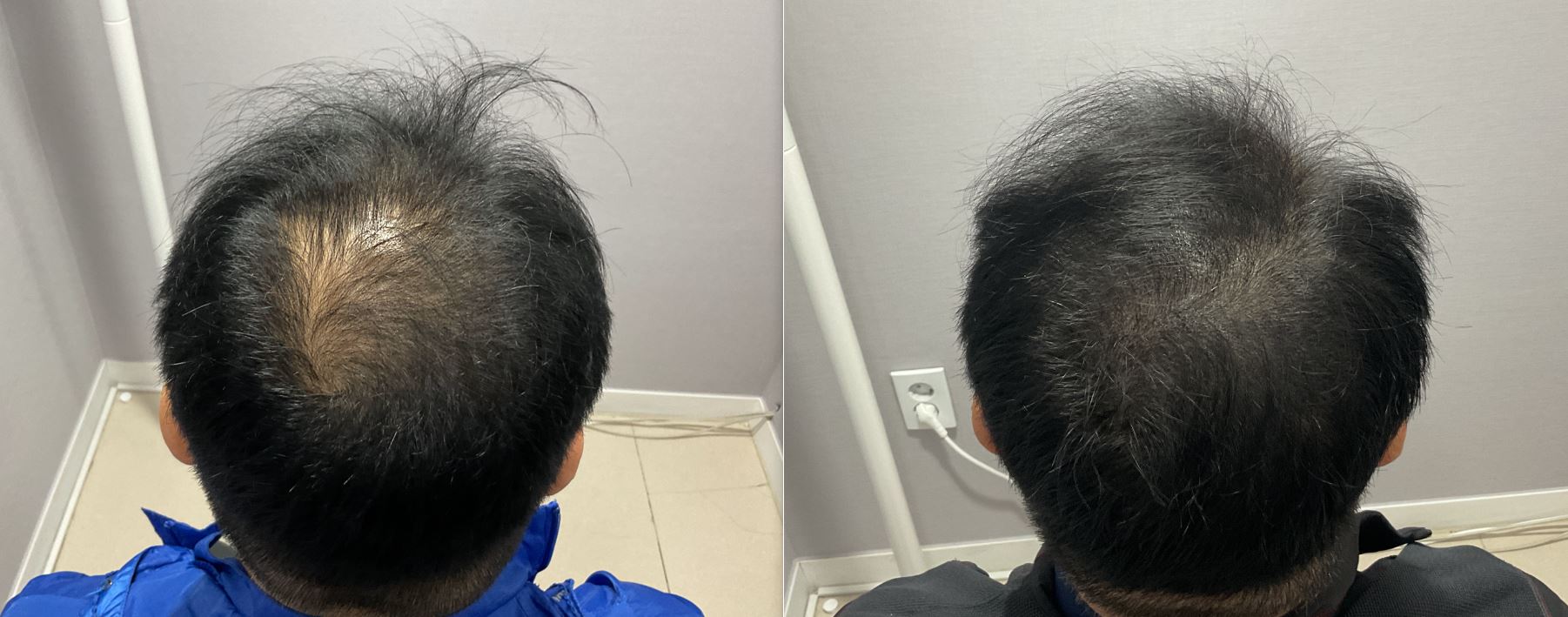 /filedata/md_board/20260212142216_AZrn8hq3_ECA095EC8898EBA6AC5284-429.JPG 전후사진