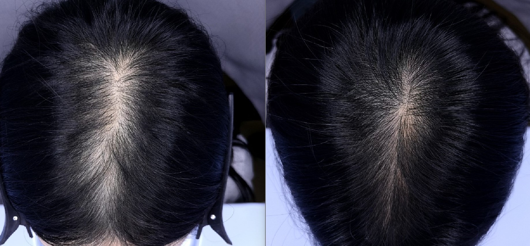 /filedata/md_board/20260212142332_3vTHWtdo_6mo_EAB080EBA5B4EBA7883.jpg 전후사진