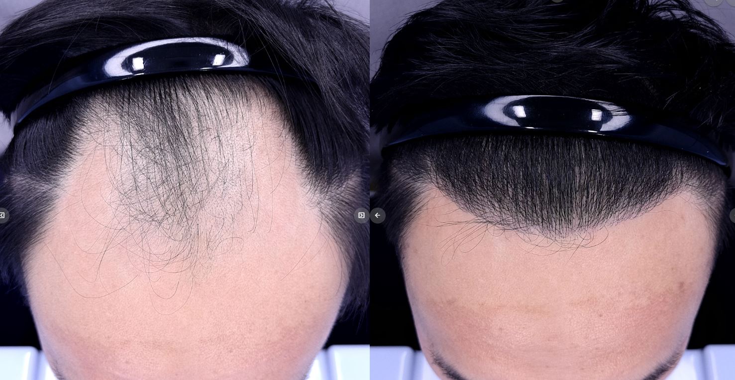 /filedata/md_board/20260212142748_49OKUx1j_EC9EA50EC9691_EB8B98_m.mid_7mo_28329.JPG 전후사진