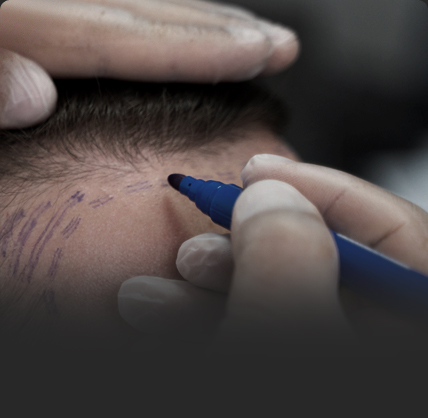 연세모벨르의원 모발이식