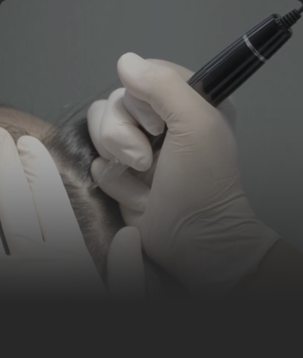 연세모벨르의원 SMP 두피문신